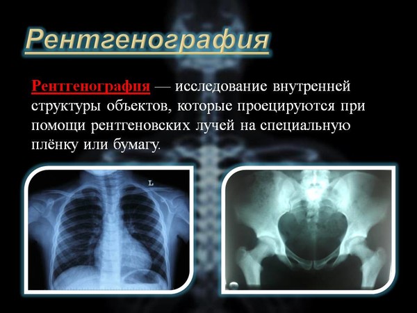 Рентген на дому Москва, Флюорография на дом Москва, Цифровой рентген на дому Москва, Травматолог на дом Москва, ЛОР на дом Москва , Стоматолог на дом, Нарколог на дом Москва, Психолог на дом, Невролог на дом, УЗИ на дому Москва, ЭКГ на дому Москва, Анализы на дому Москва, бесплатно по полису ДМС добровольное медицинское страхование. 
Балканская рамка - ( аренда и продажа) ; 
#рентгеннадому #рентгеннадомуМосква 
Рентген на дому Москва, Подмосковье, Московская область, Вороново, Красная Пахра, Дмитров, Сергеев Пасад, Орехово Зуево, Новые Ватутинки, Мытищи, Одинцово, Люберцы, Подольск, Троицк, Московский, Красногорск, Лобня, Видное, Новая Москва, Домодедово , Внуково, Красногорск , Дедовск, Истра, Клин, Чехов, Серпухов, 
#рентген_на_дому_шейки_бедра #флюорография_на_дом 
Московский рентген на дому, Рентген на дому Москва, Флюорография на дом Москва, Цифровой рентген на дому Москва, Травматолог на дом Москва, ЛОР на дом Москва , Стоматолог на дом, Нарколог на дом Москва, Психолог на дом, Невролог на дом, УЗИ на дому Москва, ЭКГ на дому Москва, Анализы на дому Москва, бесплатно по полису ДМС добровольное медицинское страхование. 
#Московский_рентген_Рентген_на_дому
когда никто вас не видит и не будет мешать, и проведите следующую процедуру. 
Залейте 10 г желатина 40 мл холодной воды, размешайте и дайте постоять 1 час для набухания. За это время разотрите 10 г окиси цинка и 40 г глицерина (продаются в аптеке) до однородной массы. Смешайте набухший желатин с цинково-глицериновой смесью и подогрейте на водяной бане до полного растворения желатина. 
Отрежьте три полосы широкого бинта длиной 30-40 см, смочите в полученном желе и наложите в такой последовательности: сначала одной полосой бинта охватите овал лица (прижимая подбородок), приглаживая бинт снизу вверх к вискам. 
Вторую пропитанную полосу наложите на лоб (если полоса слишком длинная, сложите ее вдвое). Третьей полосой закройте среднюю часть лица от уха до уха. Поверх бинта нанесите еще один слой смеси. Эффект от этой процедуры очень впечатляет.
#рентген_в_москве, #рентген_легких, #перелом_шейки_бедра, #шейка_бедра, #сделать_рентген, #сделать_рентген_на_дому, #вызвать_врача, #вызвать_врача_на_дом, #врач_на_дом, #вызвать_травматолога, #травматолог_на_дом, #перелом_ребер, #вправить_вывих, #травматолог, #перелом, #травма #вывих, #флюорография, #флюорография_на_дому, #ушиб, #пневмония #функциональная_кровать #рама_балканского 
#рентгеннадому #рентгеннадомуМосква 
#Рама_Балканского 
#травматолог_на_дом_Москва 
#рентген_на_дому_шейки_бедра_Москва 
#рентген_на_дому_лёгкие_Москва 
#рентген_на_дому_позвоночника_Москва 
#рентген_на_дому_отзывы_Москва 
#сделать_рентген_на_дому_Москва 
#вызвать_рентген_на_дом_Москва 
#рентген_на_дому_тазобедренного_сустав 
#Московский_рентген_Рентген_на_дому_шейки_бедра